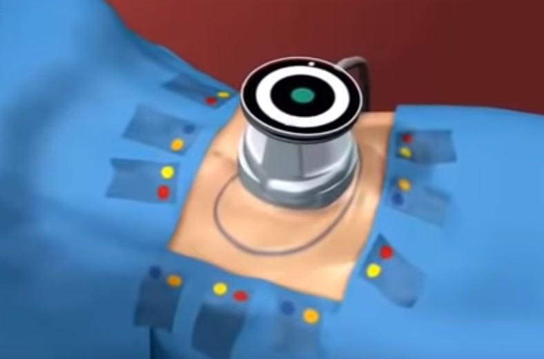 ultrasonic-cavitation-video